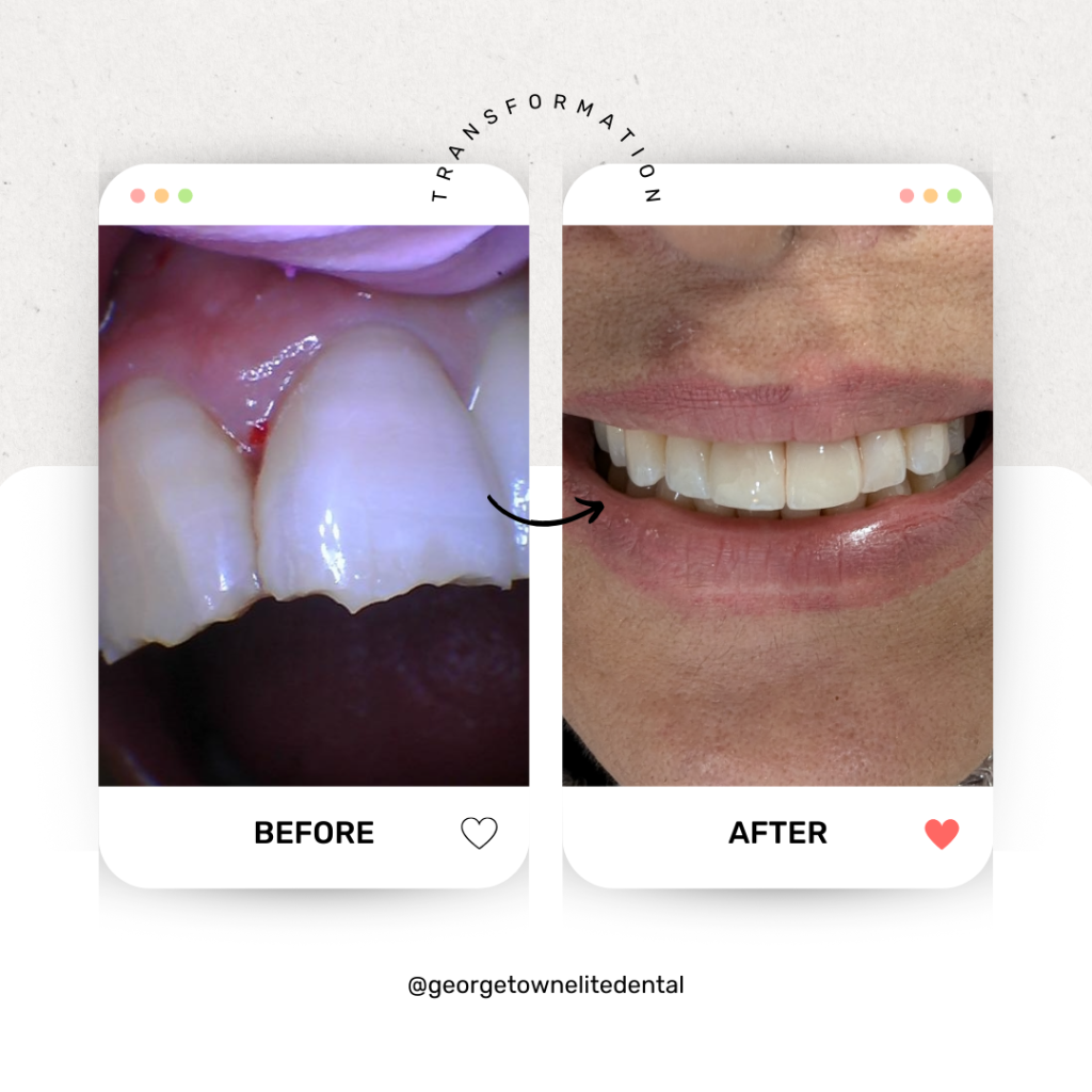 Dental Implants in Georgetown