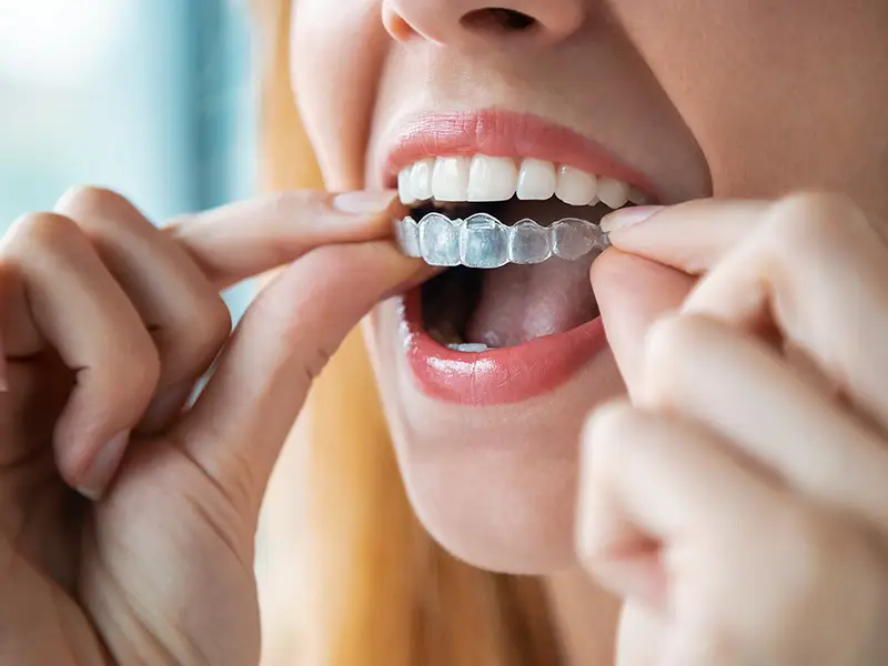 Female putting on clear aligner | Best Dentist in Georgetown