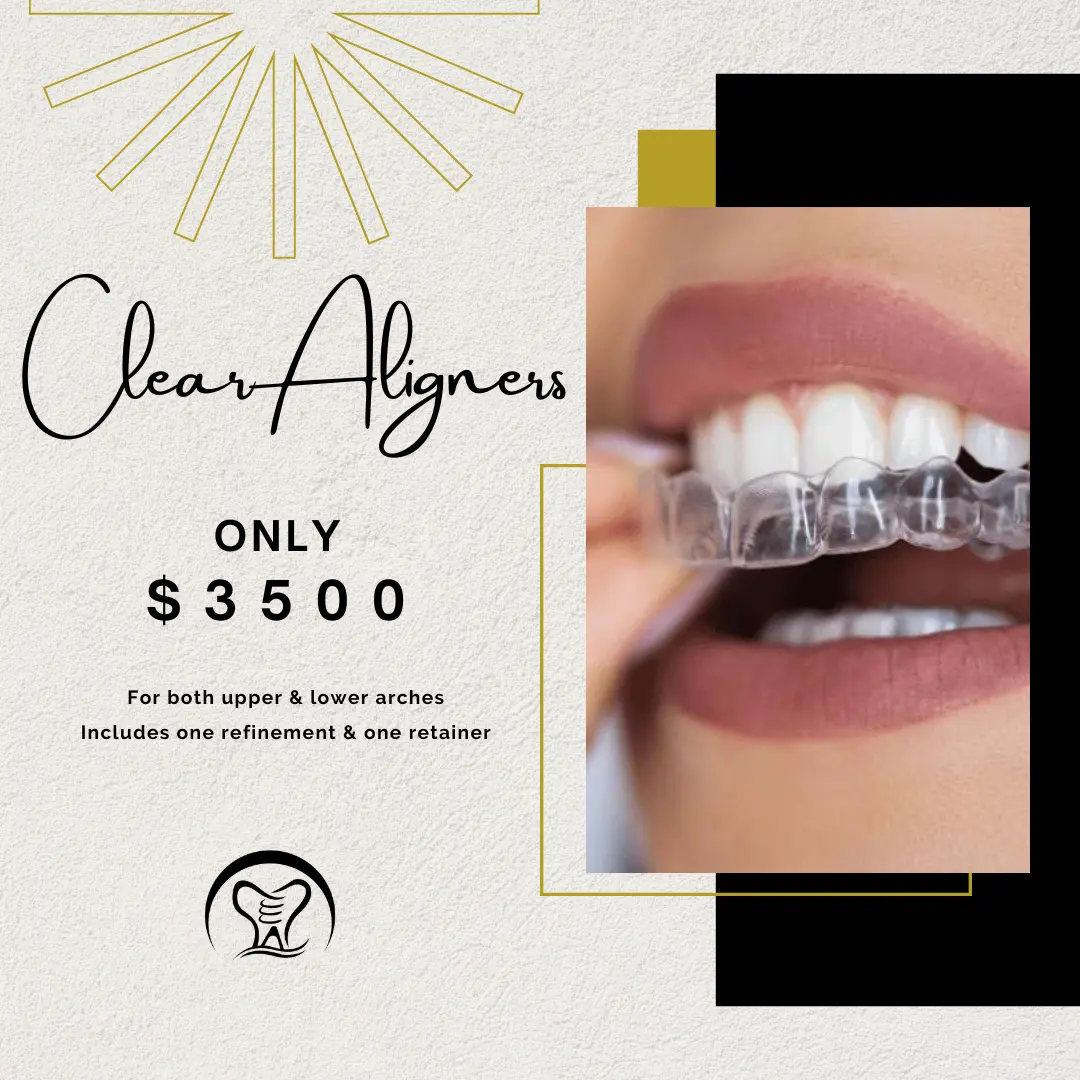 Clear aligners on teeth showing orthodontic treatment, priced at $3500 for upper and lower arches including refinement and retainer