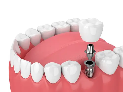 Single dental implant